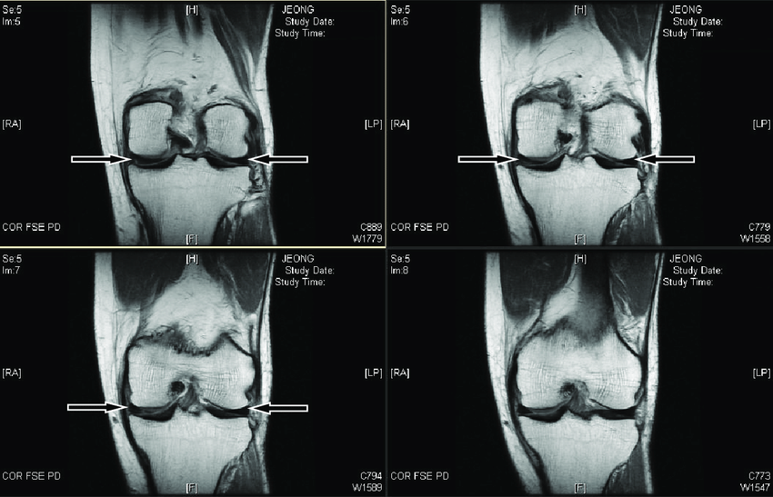 MRI LEFT KNEE